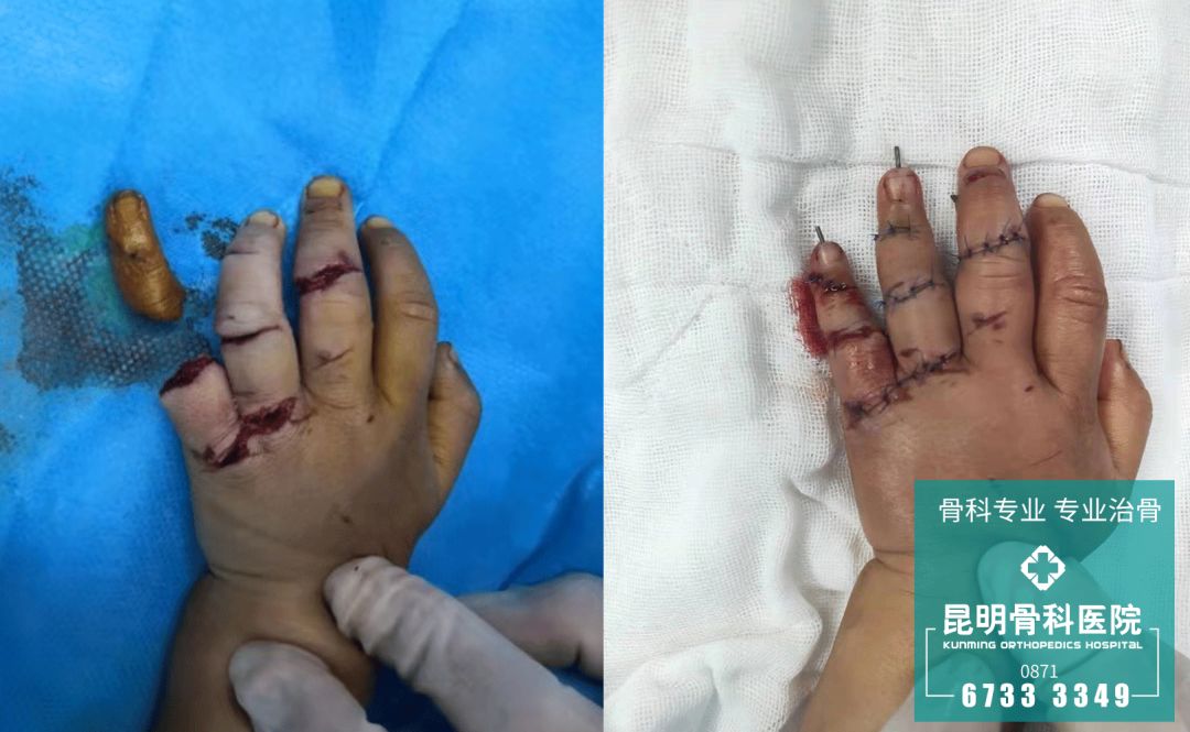 小羿断指再植前后得益于医生的精心手术,两名患者的手指均得到了及时