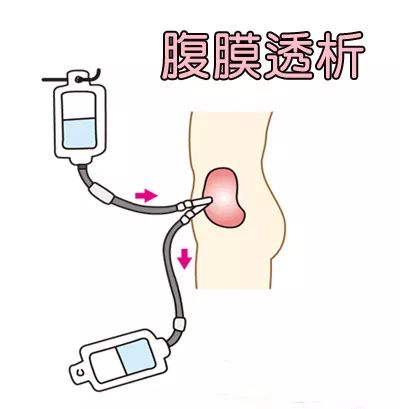 科普腹膜透析新方法自动腹膜透析