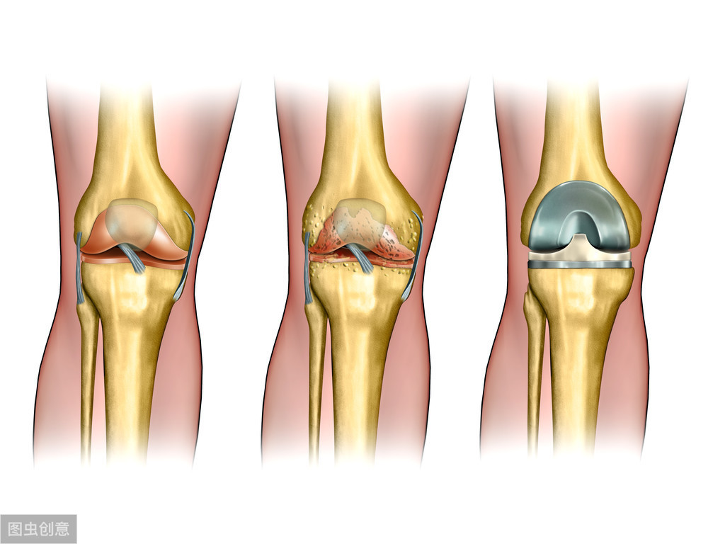 膝关节疼痛久治不愈当心是股骨头坏死在作怪