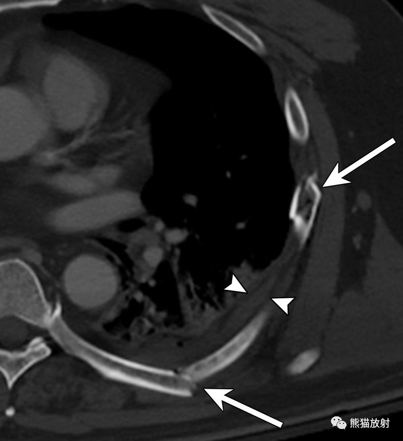 肋骨外伤丨影像表现,并发症!_损伤