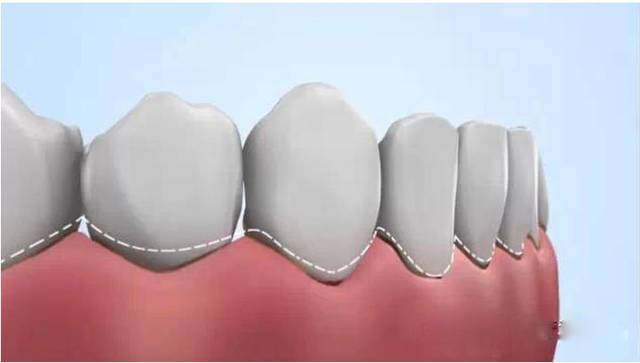 (3)暴露的牙根面易發生齲壞;(2)伴有牙齦乳頭退縮時,牙間隙增大,常