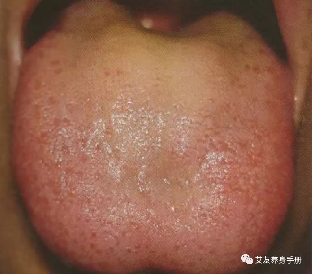 【艾学习】六淫证素与舌象_舌苔