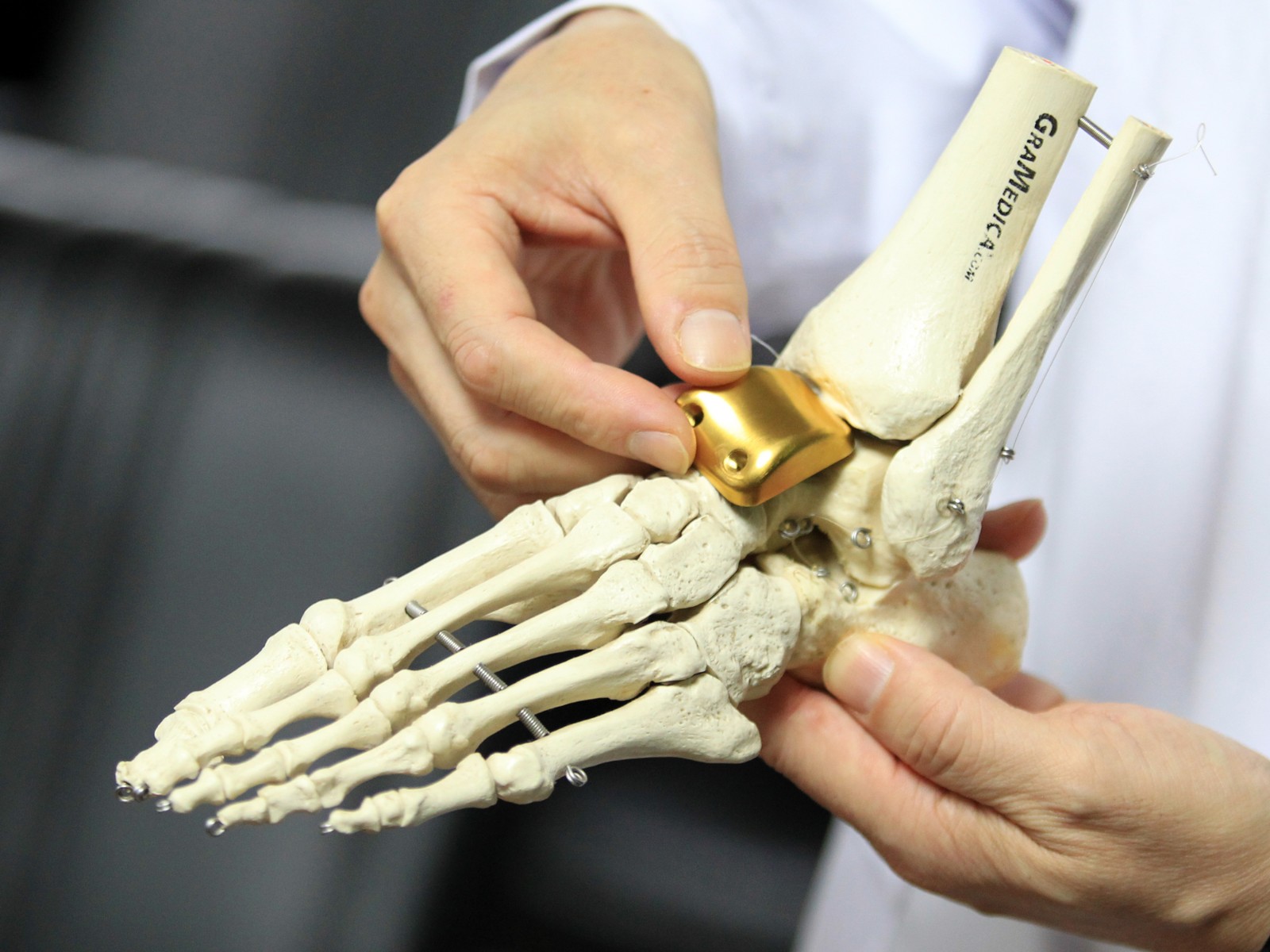 "为了保证全球首例3d打印距骨表面假体置换的成功开展,红会医院足踝