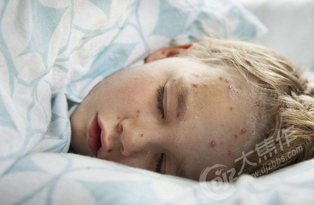 临床表现主要为皮肤粘膜出现斑疹,丘疹,水痘,可伴发热,体温38℃以上