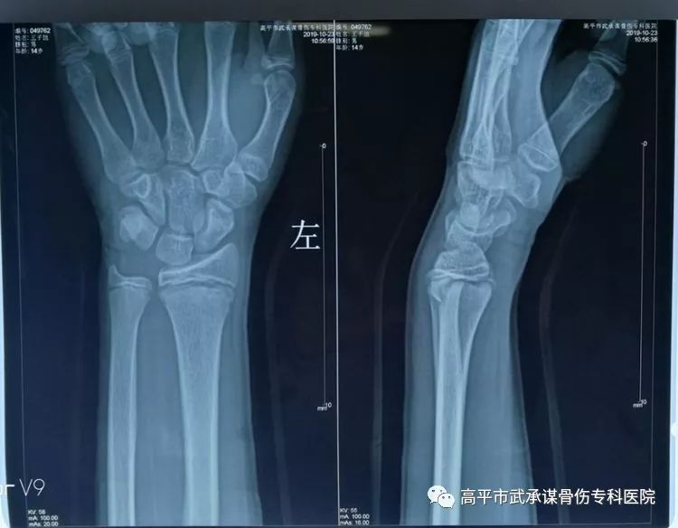 正常桡骨图片,桡骨骨折图片,正常桡骨远端骨图片(第6页)_大山谷图库
