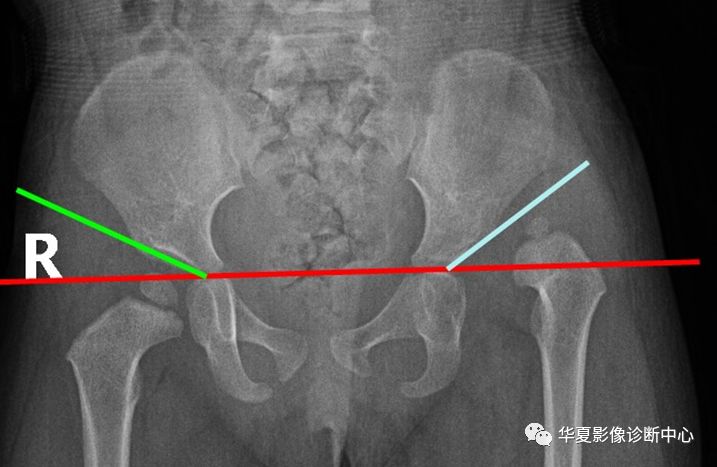 髋关节的x线测量