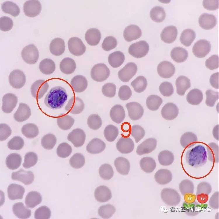 ▼「(左)疟原虫未成熟裂殖体(右)疟原虫雌配子体」形态特征:(左)