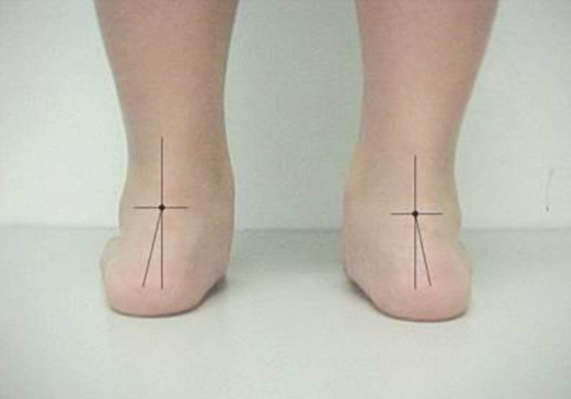 4岁宝宝脚丫变形,只因妈妈太过"节俭",害了孩子还不自知_足部