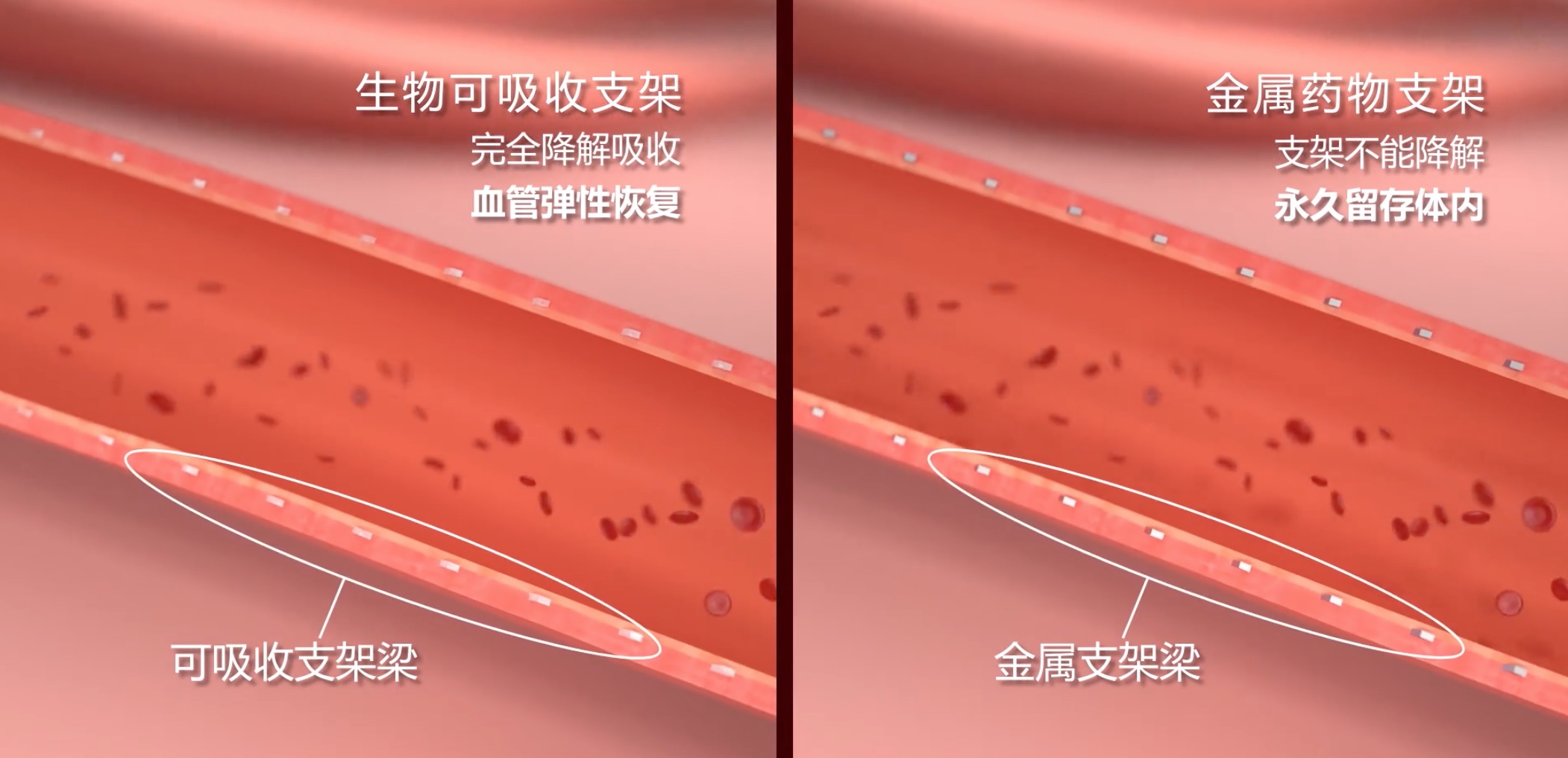 心跳科技的力量|乐普医疗推出首个国产生物可吸收支架