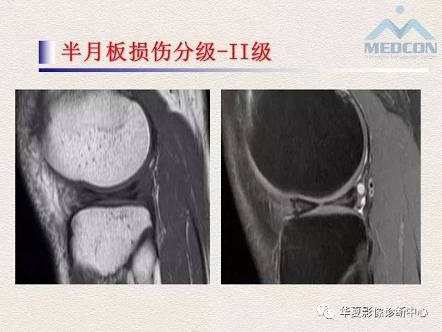 半月板常见病变及正常变异的mri诊断