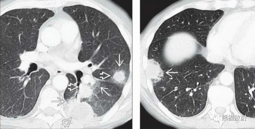 肺麴黴菌病血管侵襲性丨ct表現診斷要點
