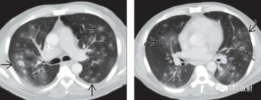 肺麴黴菌病血管侵襲性丨ct表現診斷要點