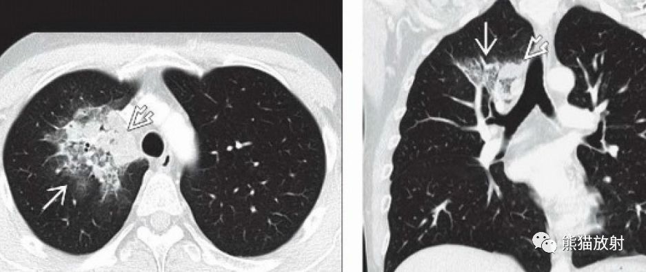 肺麴黴菌病血管侵襲性丨ct表現診斷要點