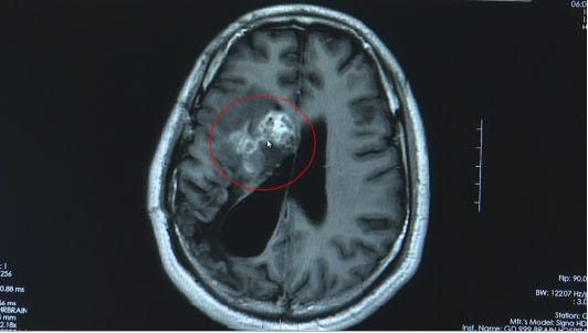 脑子长虫现实版12厘米活虫在脑子内安家十几年都是馋嘴惹的祸