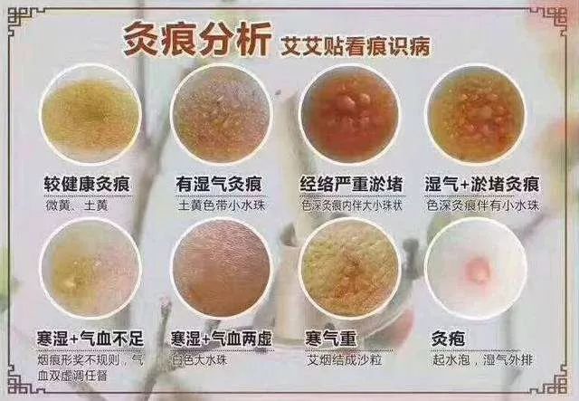 雨桐国际艾灸疗法如何使用艾灸调理女性疾病
