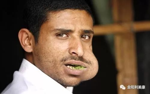 牙齿咬合不齐造成脸歪吓得我赶紧去找牙医做了个检查