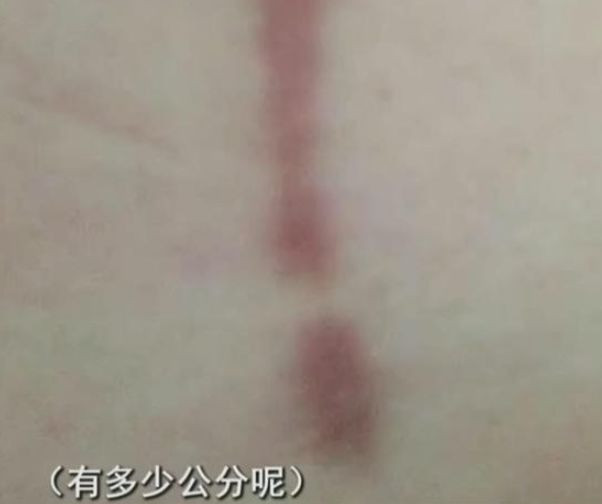 缩胸手术的疤痕图片图片