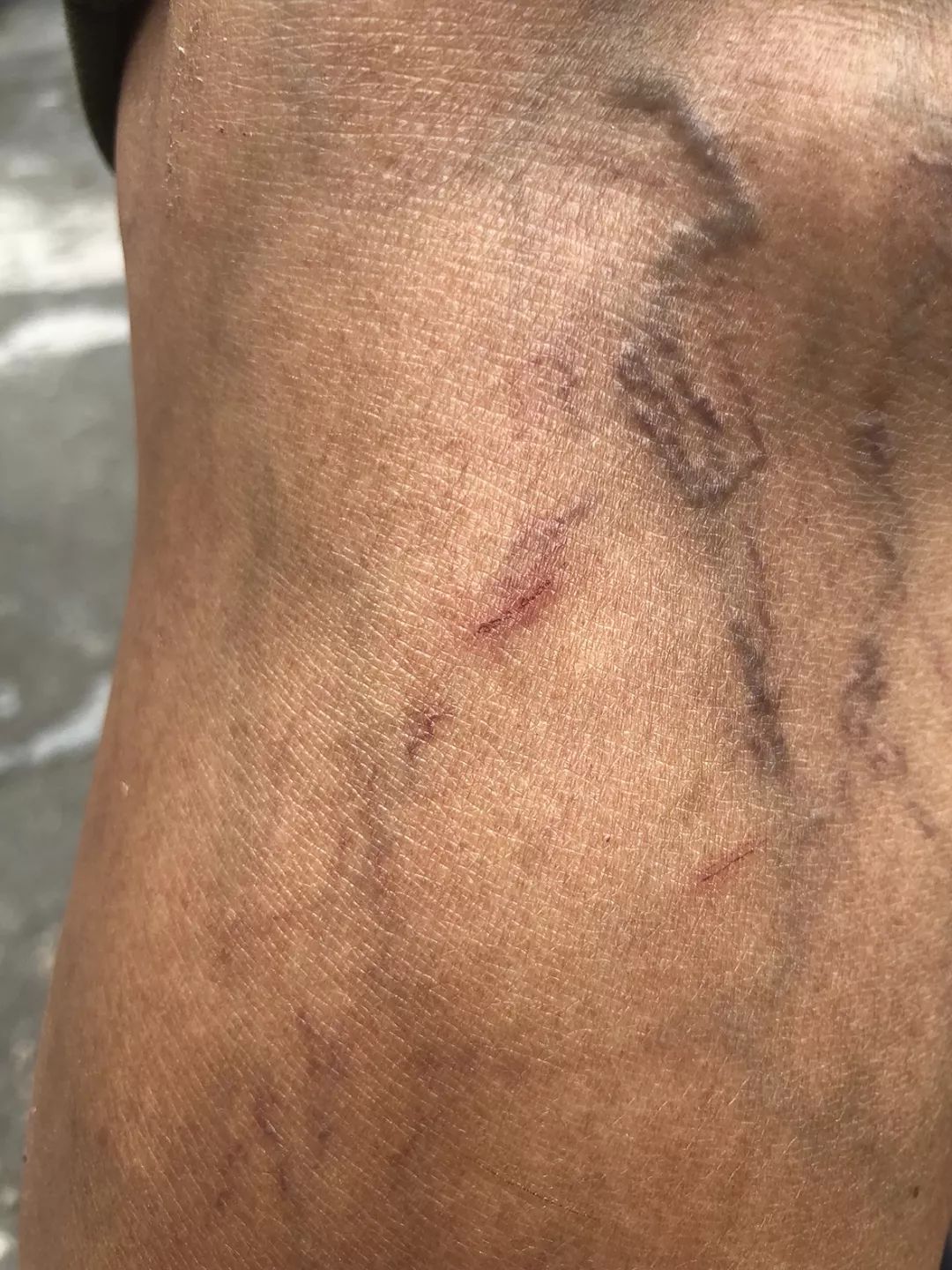 痛心东莞7岁男童遭恶狼狗扑咬致狂犬病暴露三级更痛心的是