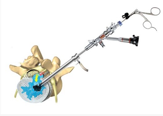 原创椎间孔镜是什么黑科技?