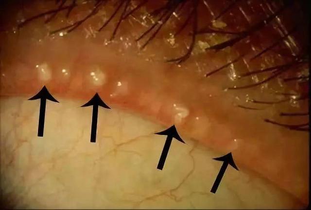 扎心!爱干净还有错?男子爱洗眼竟引发干眼症