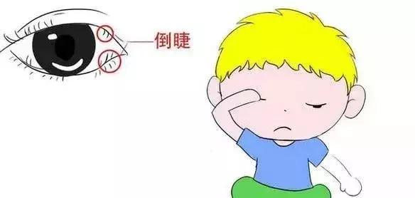 首大张兰沙眼有什么症状日常应该如何预防