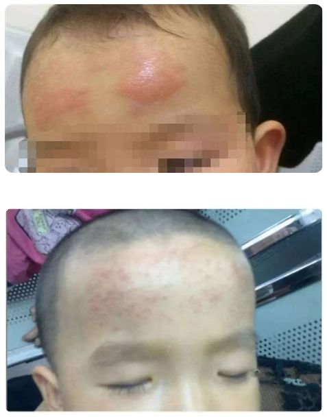 网红退热贴被"扒皮":只能物理降温,有的孩子出现过敏表现_宝宝