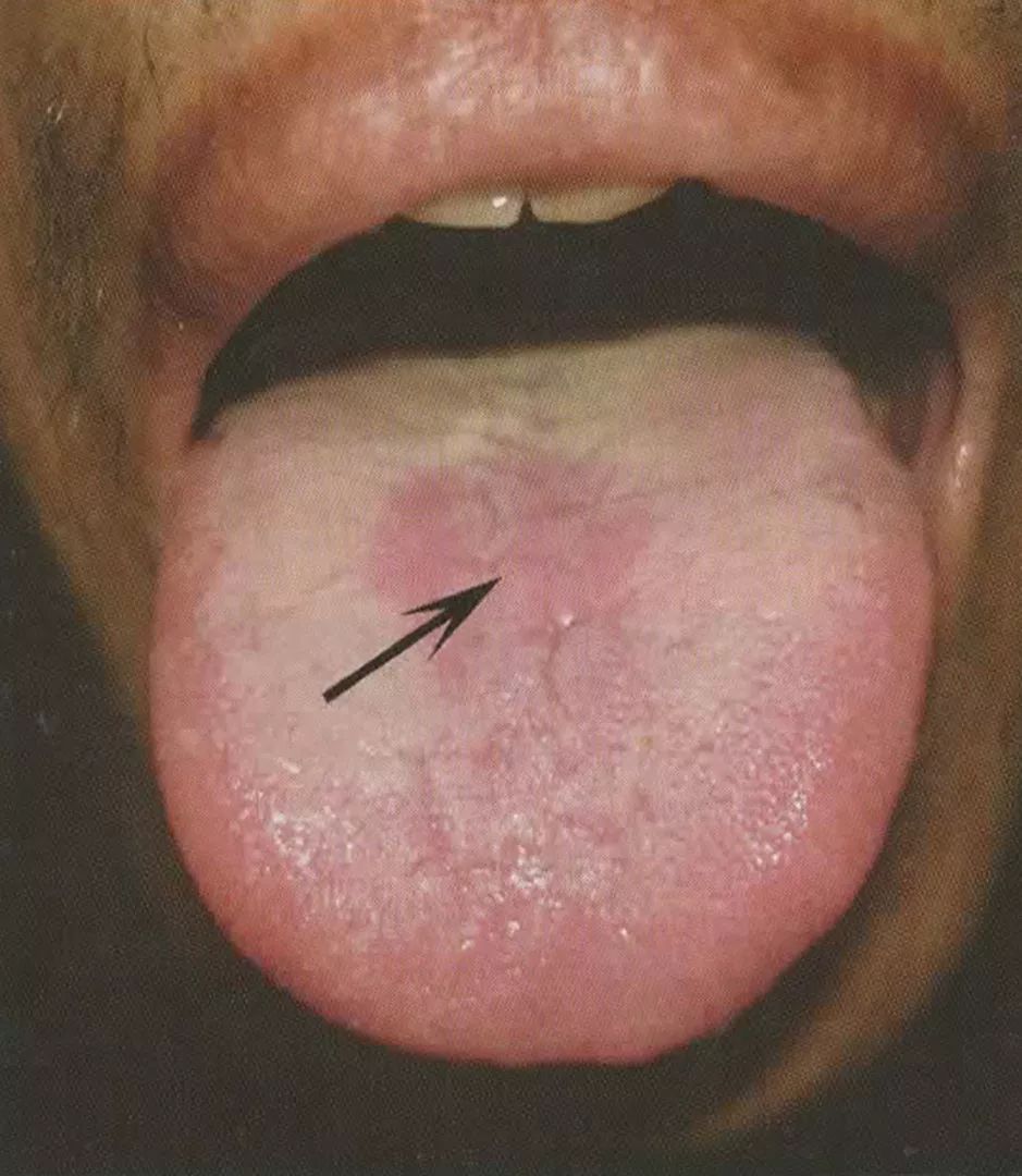 胃在舌面的分部为舌中,故舌中部剥苔,少苔,裂纹等,常与胃病有关