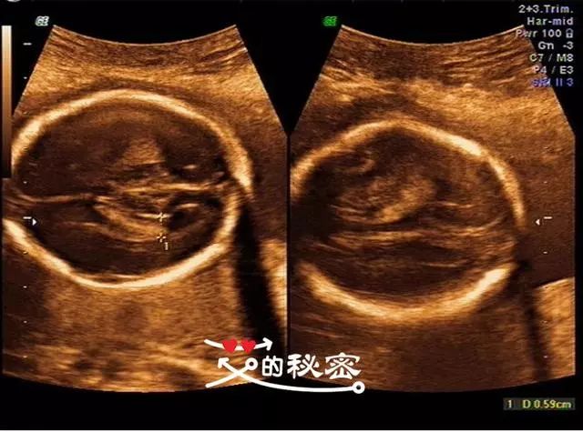 5,胎儿头部:颅骨环未见明显缺损,大脑回声可见,脑中线居中,两侧丘脑
