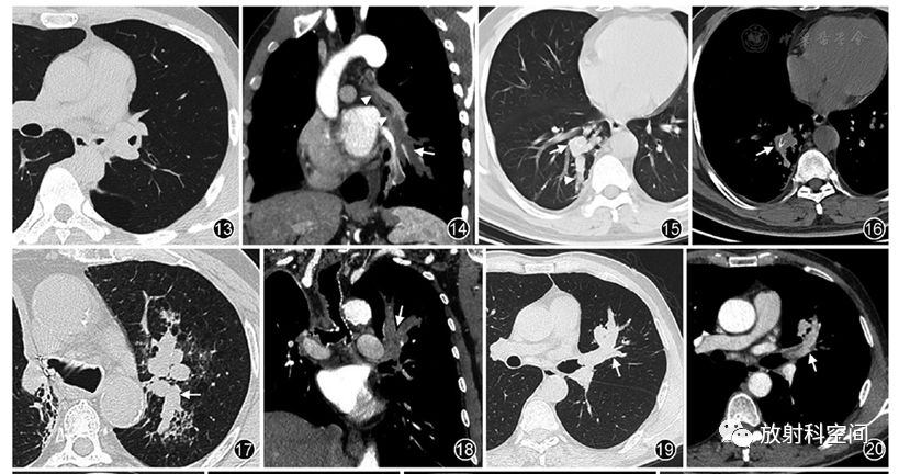 支气管黏液栓塞的影像诊断与鉴别