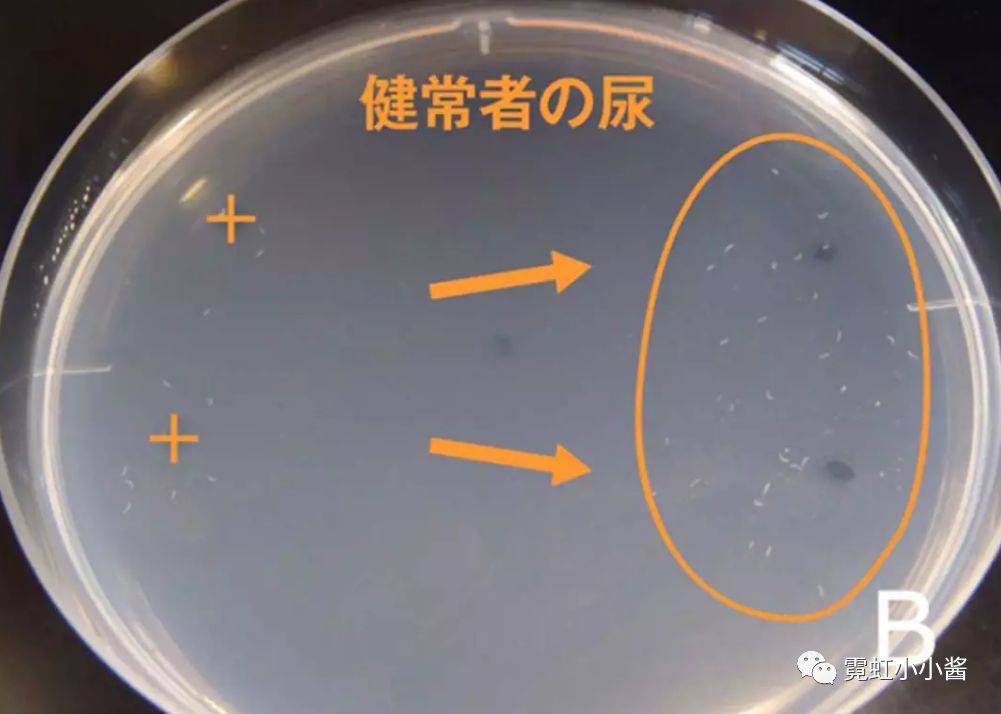 健康人尿液中的线虫排列↑癌症患者尿液中的线虫排列n