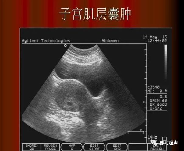 六,子宫肌壁静脉扩张子宫肌壁静脉扩张是由于子宫肌层静脉回流不畅