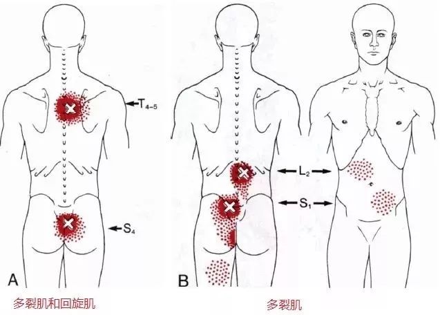 上背痛,中背痛激痛点和肌肉疼痛按摩