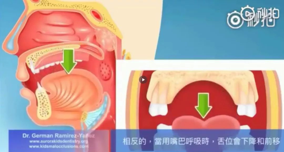 本来你的下颚骨骼发育得好好的,张嘴呼吸后每天空气都要冲进来推一推