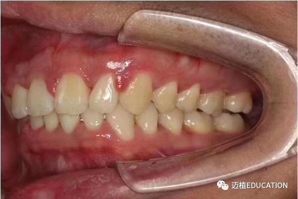 前牙严重深覆合,下颌牙弓狭窄 —武广增教授