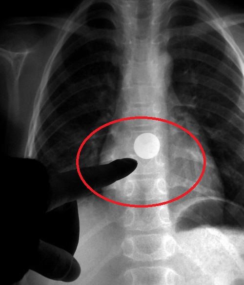 经过诊断,发现孩子的食道内有一个圆形金属异物,疑似硬币.