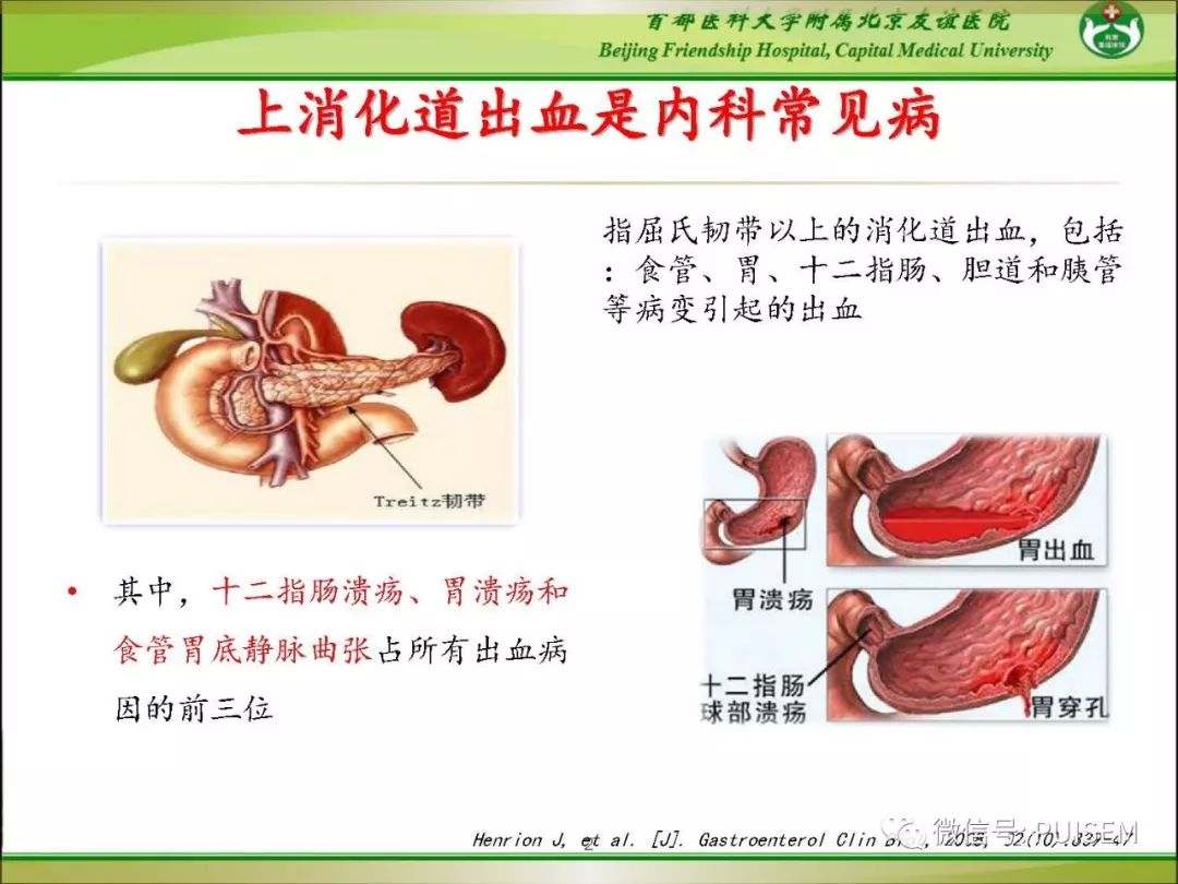 上消化道出血概念图图片