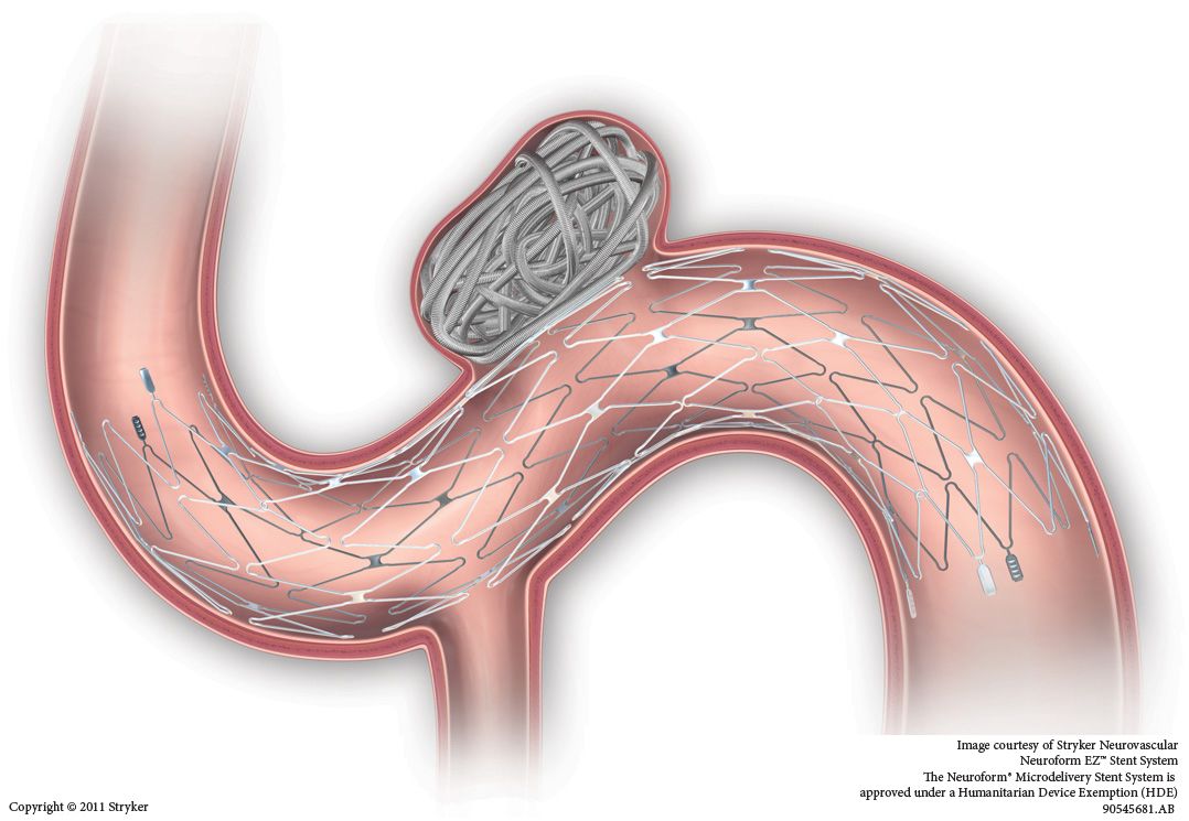 颅内动脉瘤支架图片