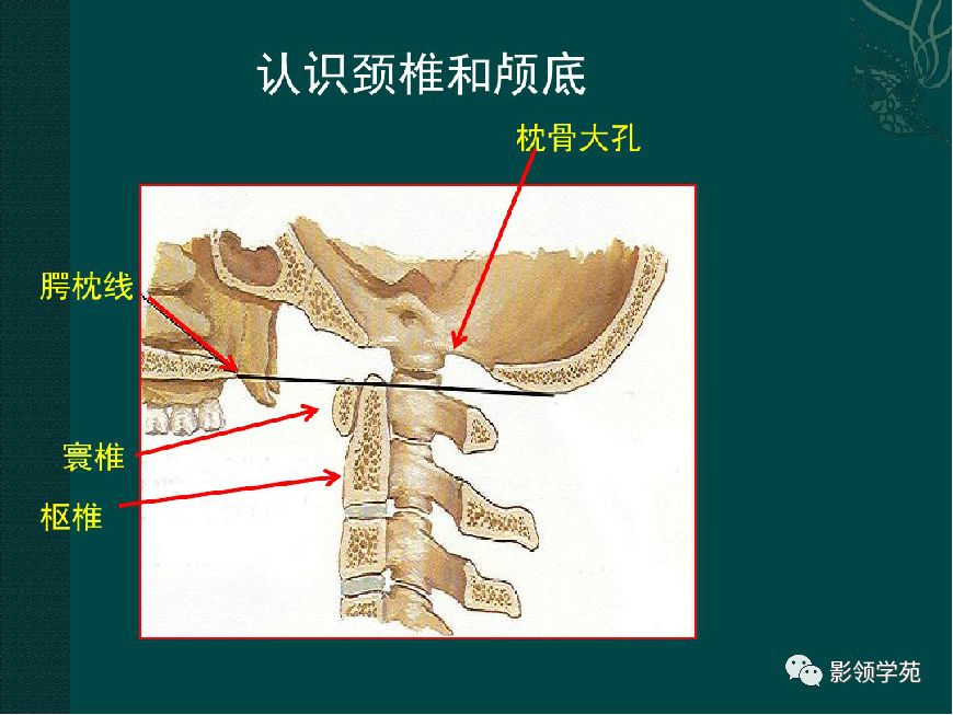 颅底凹陷症影像学诊断