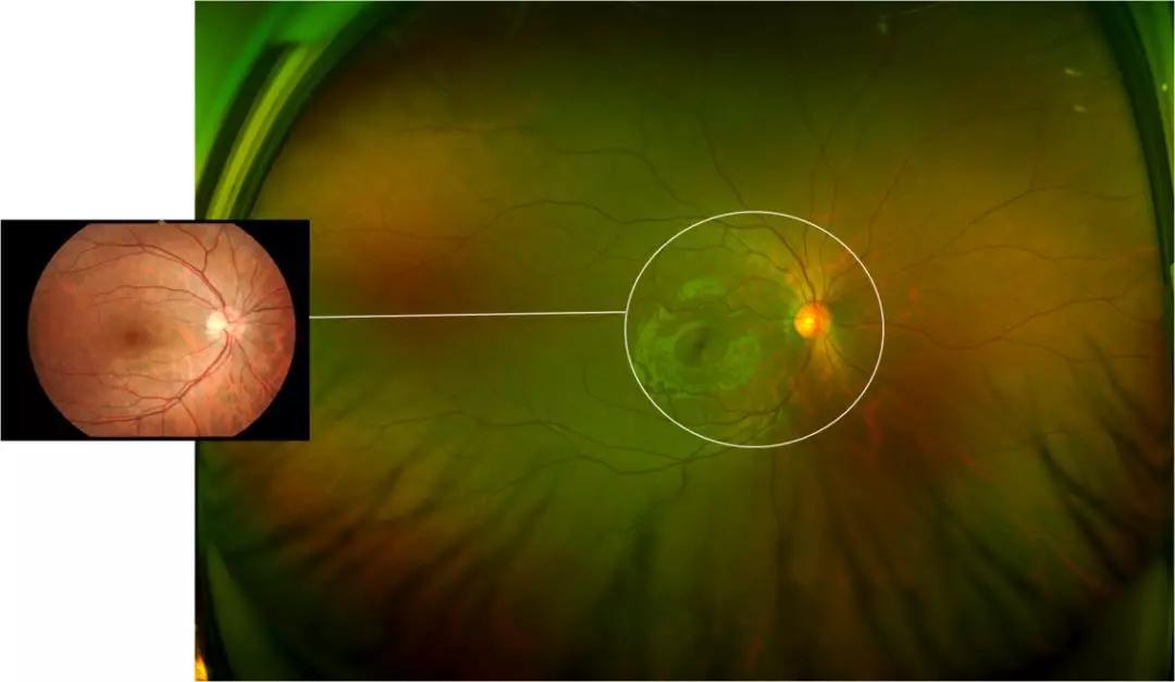 欧堡超广角眼底检眼镜落户聊城爱尔眼科医院 _检查