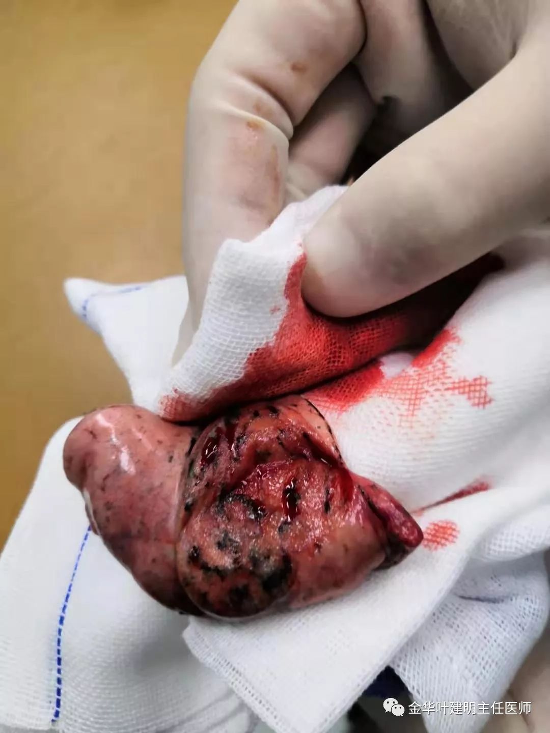 经验积累这样的磨玻璃结节会是肺癌吗