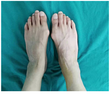 长期穿高跟鞋要小心踇外翻茂名女子就因脚趾畸形要手术截骨