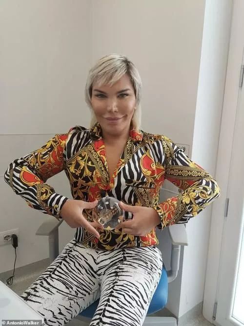 整容高达72次巴西整容狂人为减肥在胃里装气囊