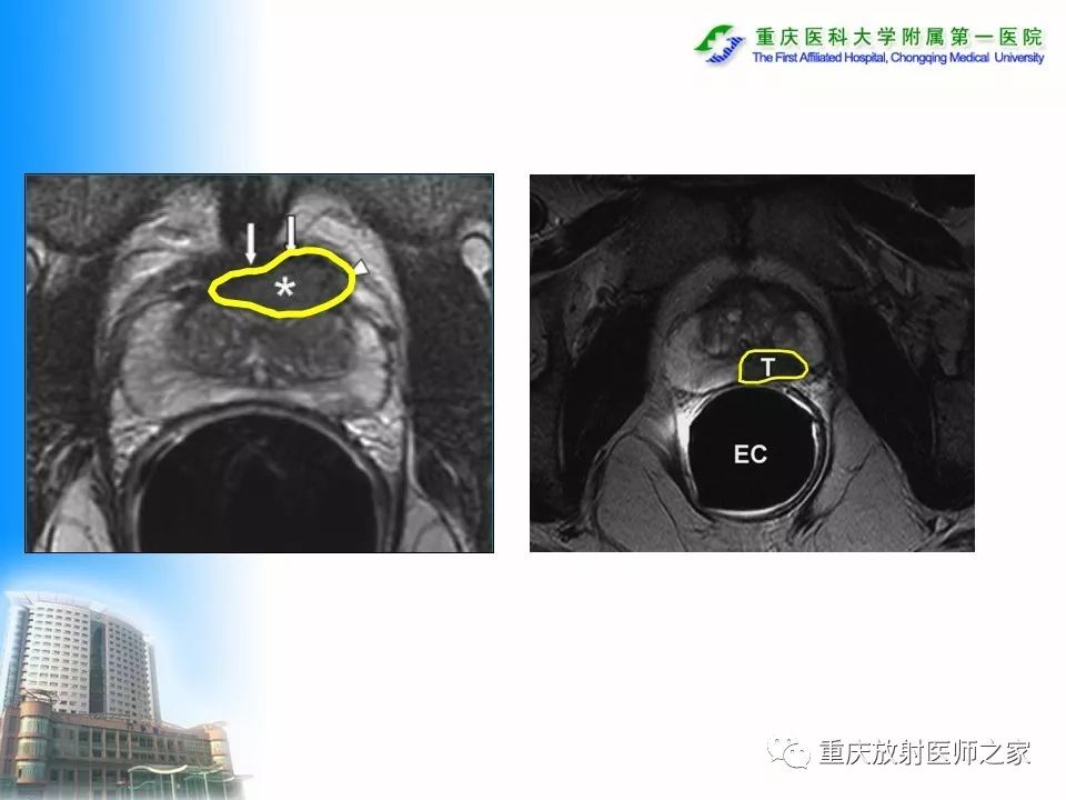 前列腺癌的磁共振诊断piradsv2