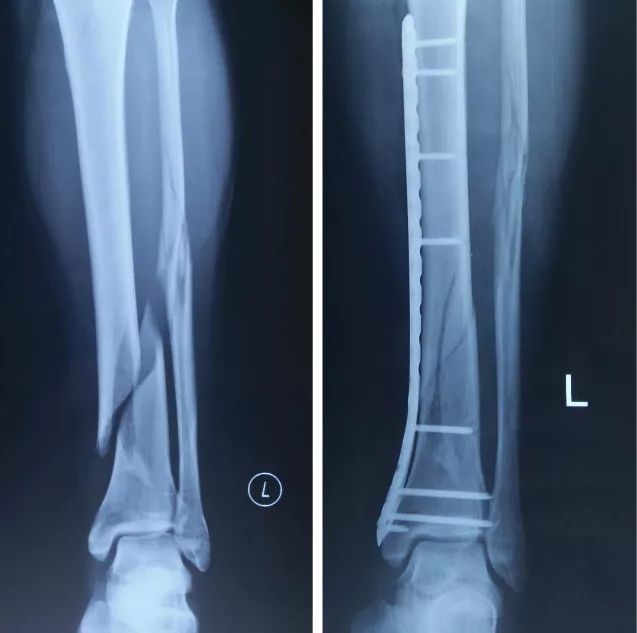 (左胫骨远端骨折术后钢板固定)患者听到钢板两个字,可能会担心植入