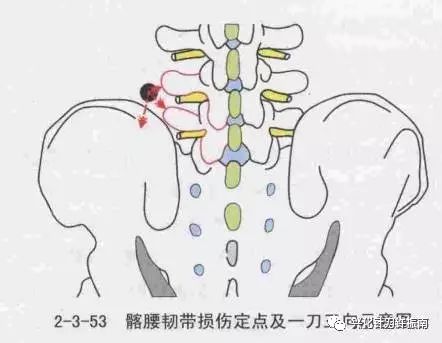 髂腰韧带损伤与针刀临证精要