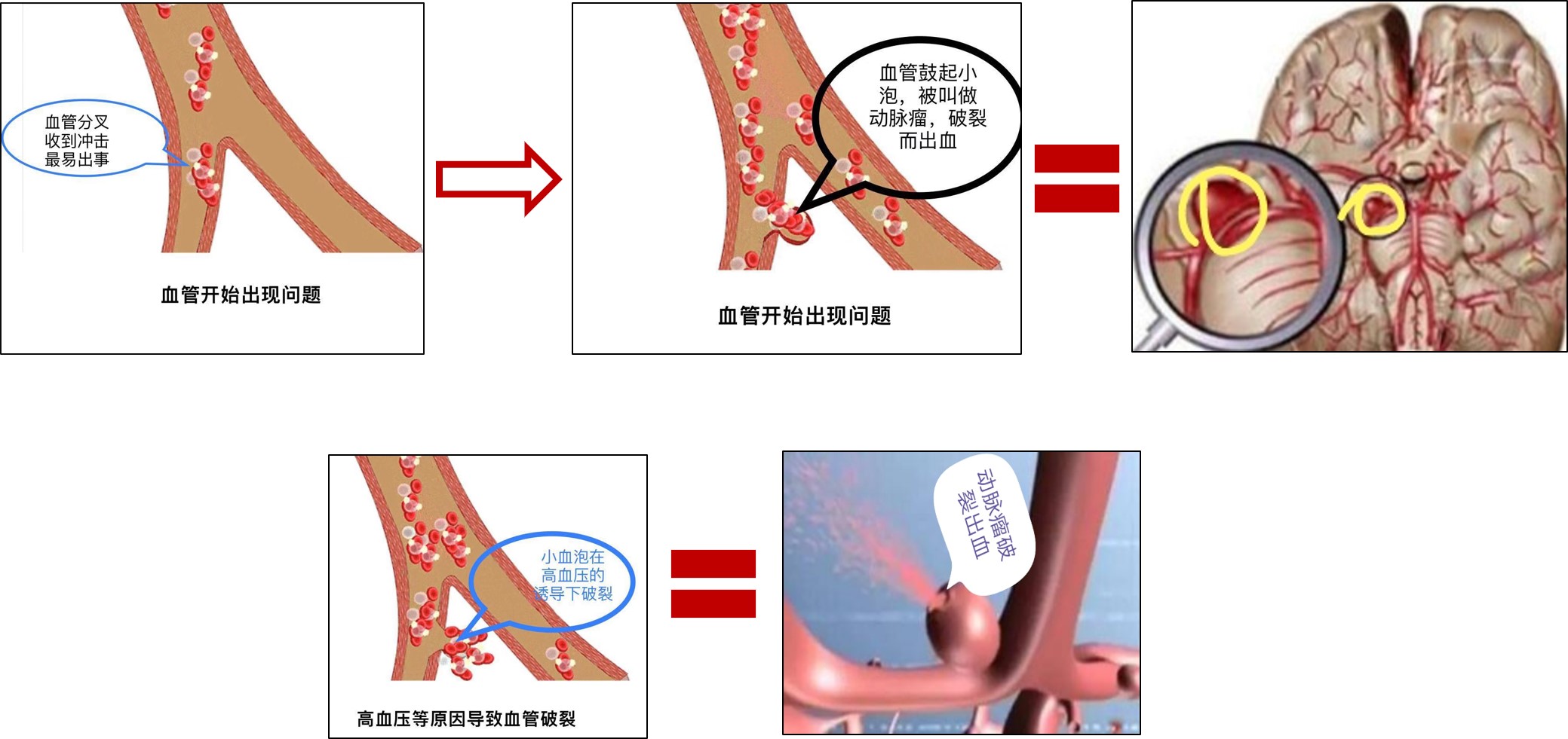 宫颈血泡图图片