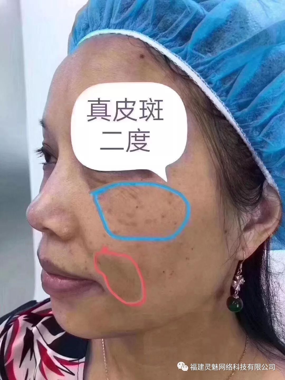 建议方案1:御芙莲激光77美颜套组(2-3疗程).