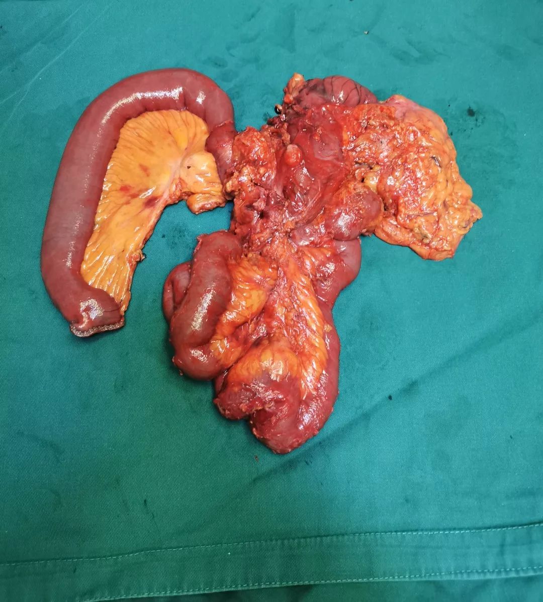 浙江一57岁大伯腹痛腹泻半个月,没想到竟是这么严重的病…_小肠