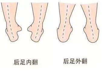 孩子足内翻了怎么办最全的矫正方法