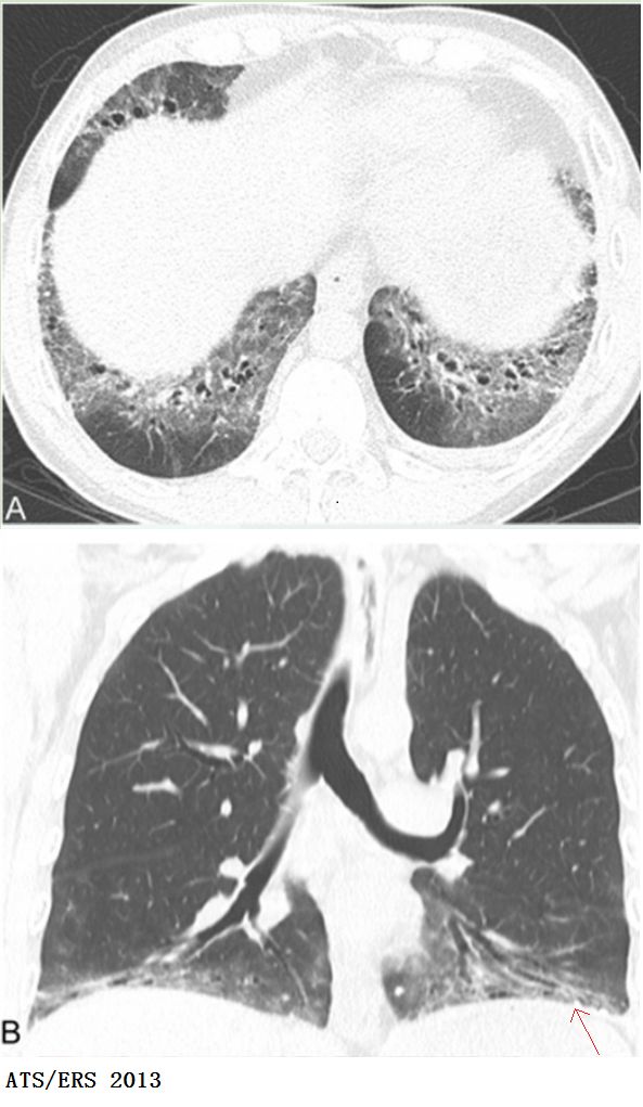 间质性肺炎ct图片特点图片